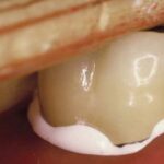 لوتینگ دندانپزشکی چیست و چه کاربردی دارد؟