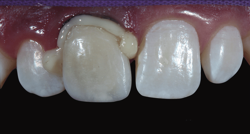 لوتینگ دندانپزشکی چیست