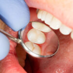 سیلر دندانپزشکی چیست و چه کاربردی دارد؟