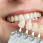 بررسی انواع باندینگ دندانپزشکی