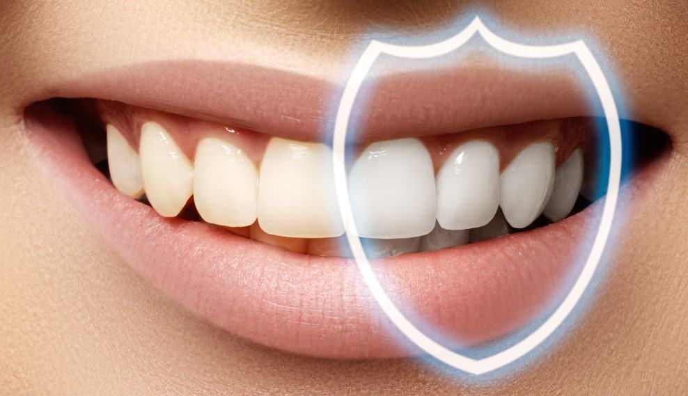 انواع باندینگ دندان پزشکی